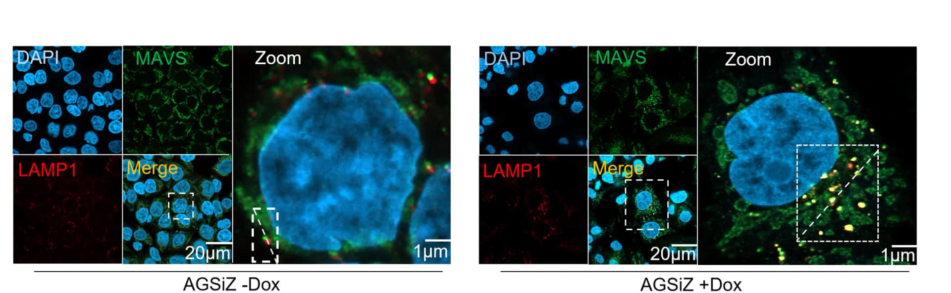 Open access visualization of Microscopy, Immunofluorescence analysis, MAVS, LAMP1, EBV+ AGSiZ gastric carcinoma
