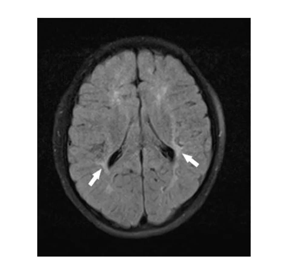 Open access visualization of Microscopy, Magnetic Resonance Imaging, FLAIR sequence, Brain, White Matter Hyperintensities