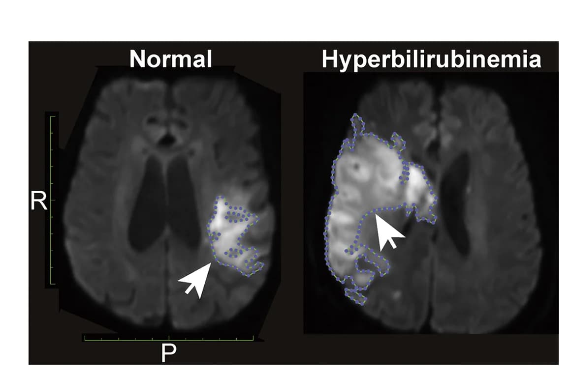 Open access visualization of Microscopy, MRI, Stroke Patients, Serum Bilirubin, Infarcted Brain Tissue