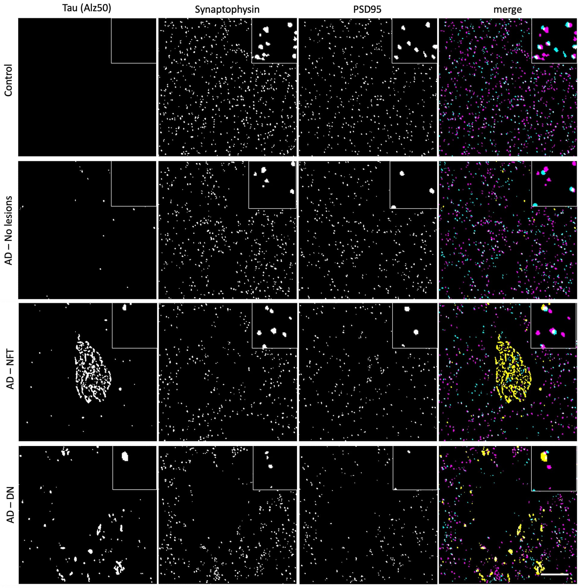 Open access visualization of Microscopy, Control, Alzheimer's Disease, Tau Aggregates, Synaptophysin