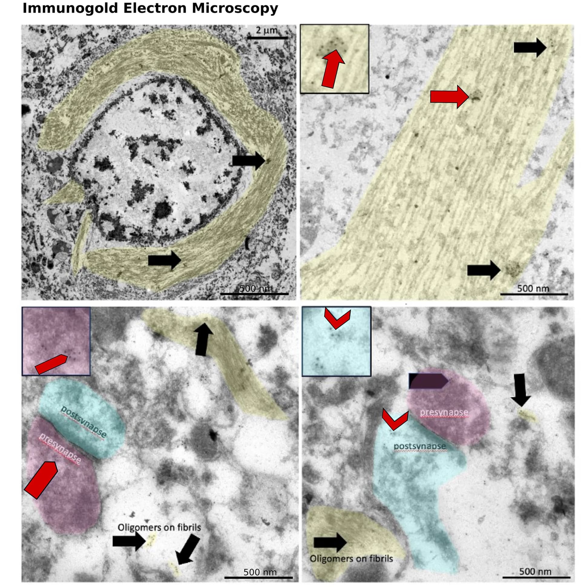 Open access visualization of Microscopy, Immunoelectron Microscopy, Oligomers, Fibrils, Neurofibrillary Tangles