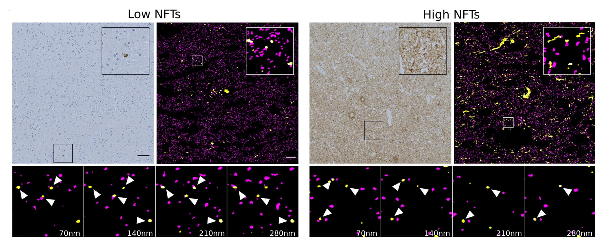 Open access visualization of Microscopy, NFT Density, Tau AT8 Immunoreactivity, Immunohistochemistry, NFTs