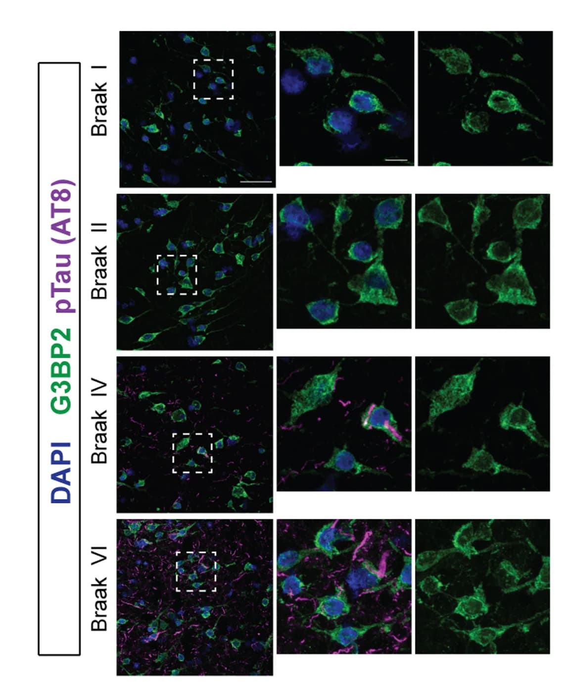 Open access visualization of Microscopy, Immunohistochemical Staining, pTau, G3BP2, AD