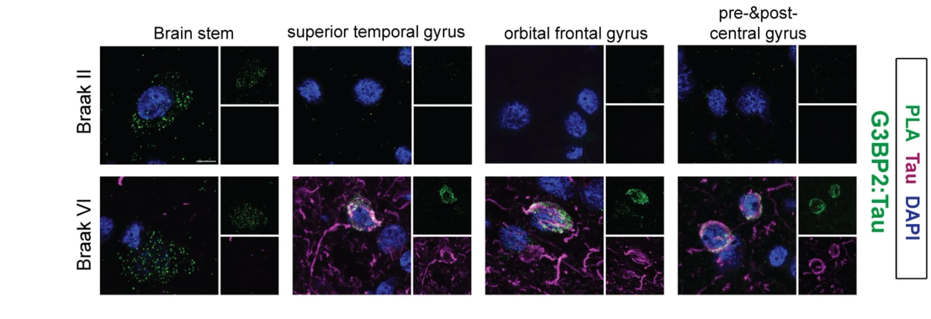 Open access visualization of Microscopy, PLA Signals, Tau Signals, Brain Regions, Braak II