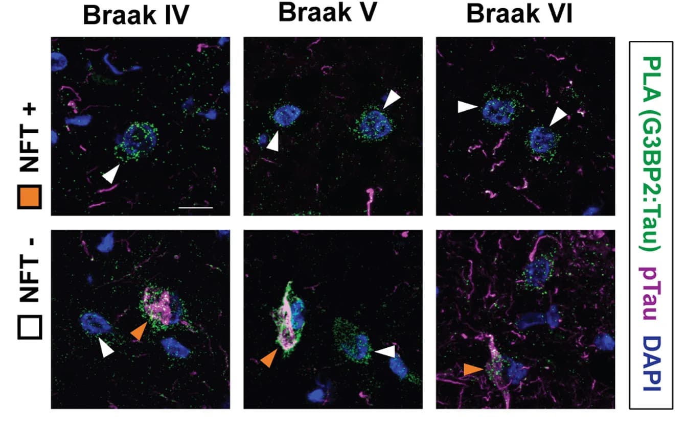 Open access visualization of Microscopy, PLA Signals, pTau, Braak Stages, AD