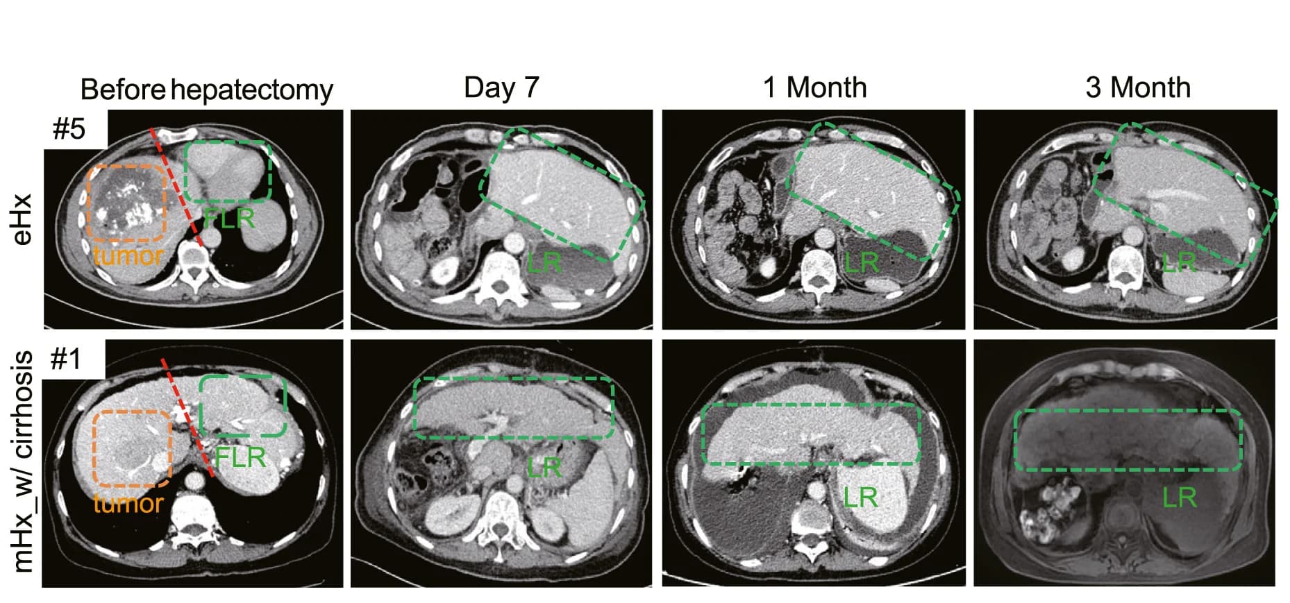 Open access visualization of Photo, Liver Regeneration, Patients, CT Volumetry, Tumor
