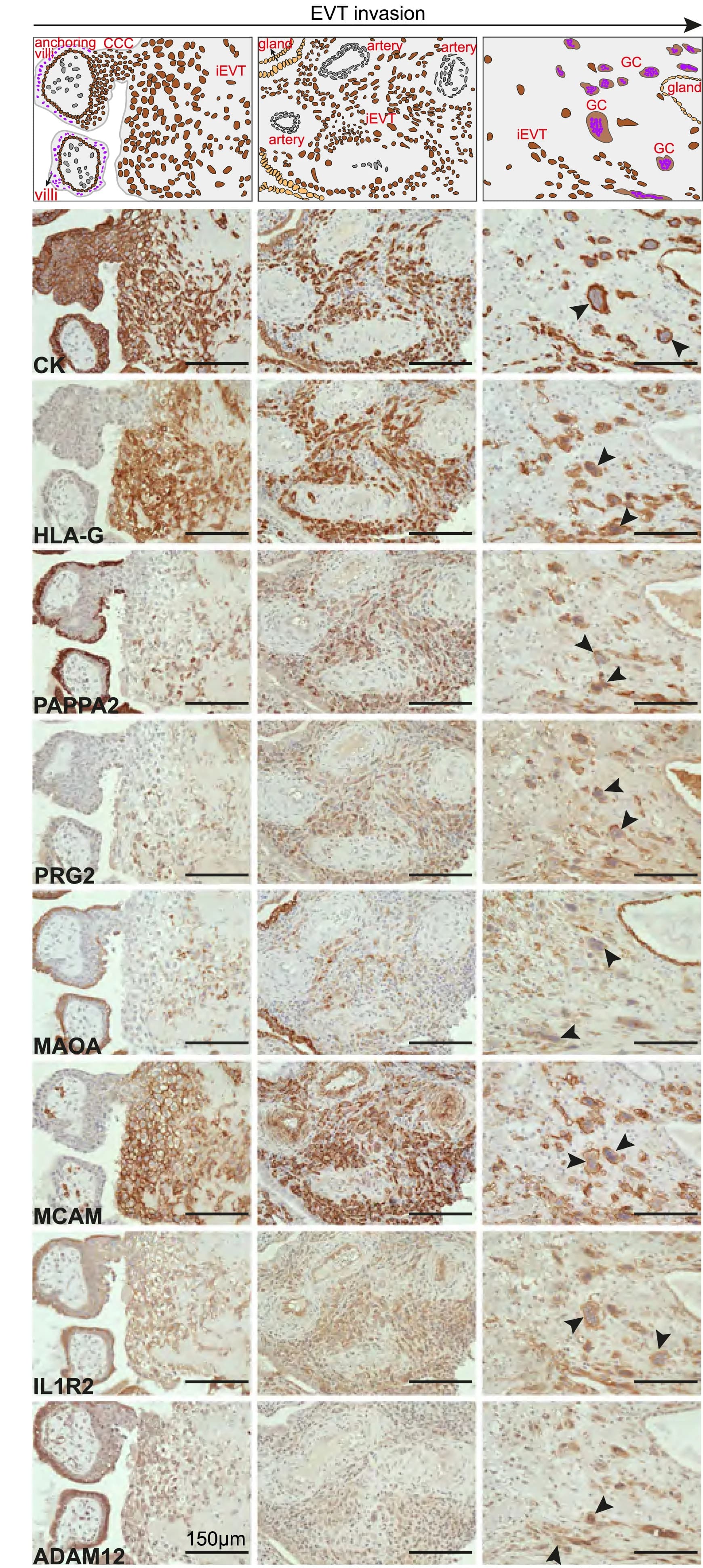 Open access visualization of Microscopy, Illustration, Immunohistochemistry, Anchoring Villus, iEVT