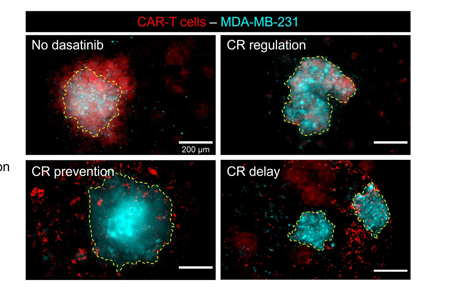 Open access visualization of Microscopy, MDA-MB-231 Aggregates, Tumor-on-Chip Perfusion, CAR-T Cells, T Cell Infiltration