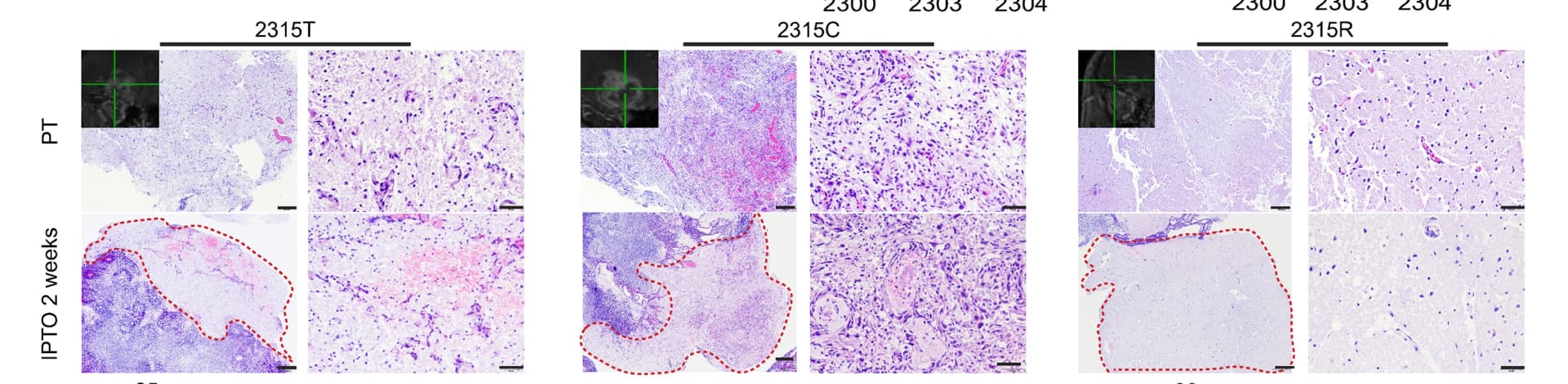Open access visualization of Microscopy, Photo, H&E Staining, GBM, PT