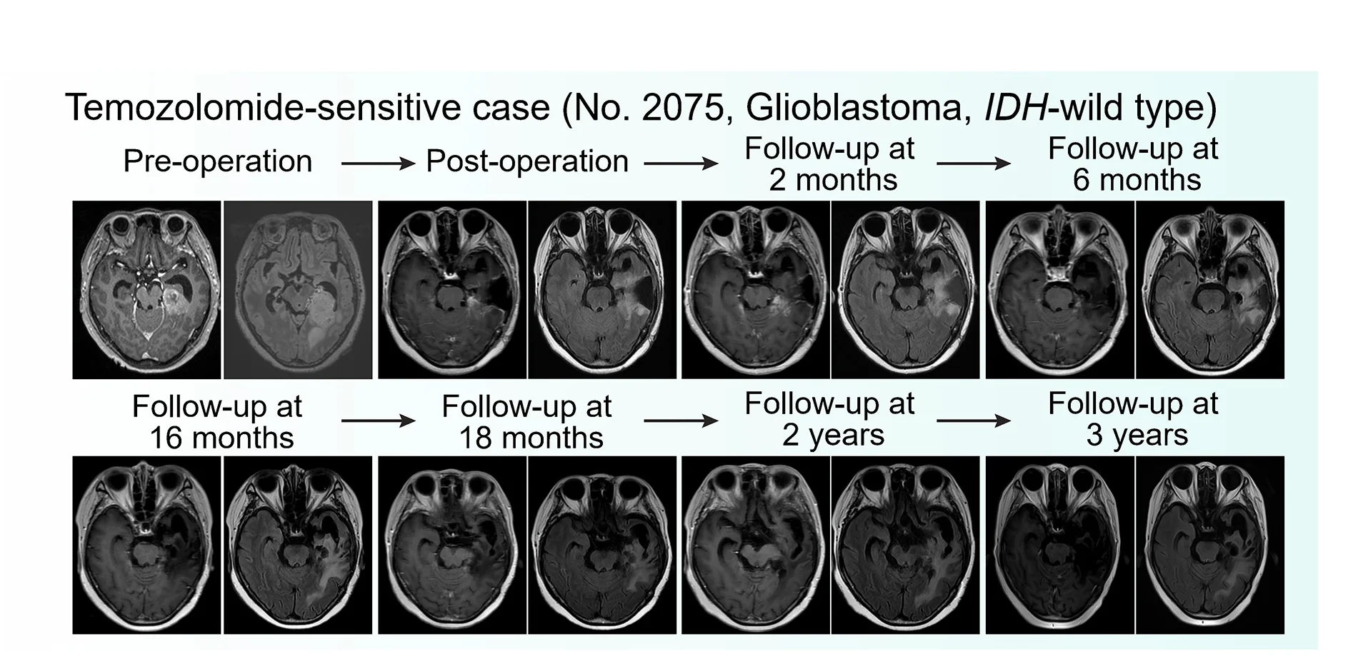 Open access visualization of Microscopy, Magnetic Resonance Imaging, MRI, PT2075, MGMTmethylated