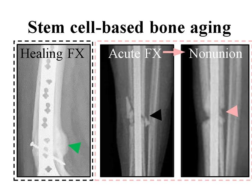 Open access visualization of Photo, X-Ray Images, Long Bone Fracture, Fracture Callus, Nonunion
