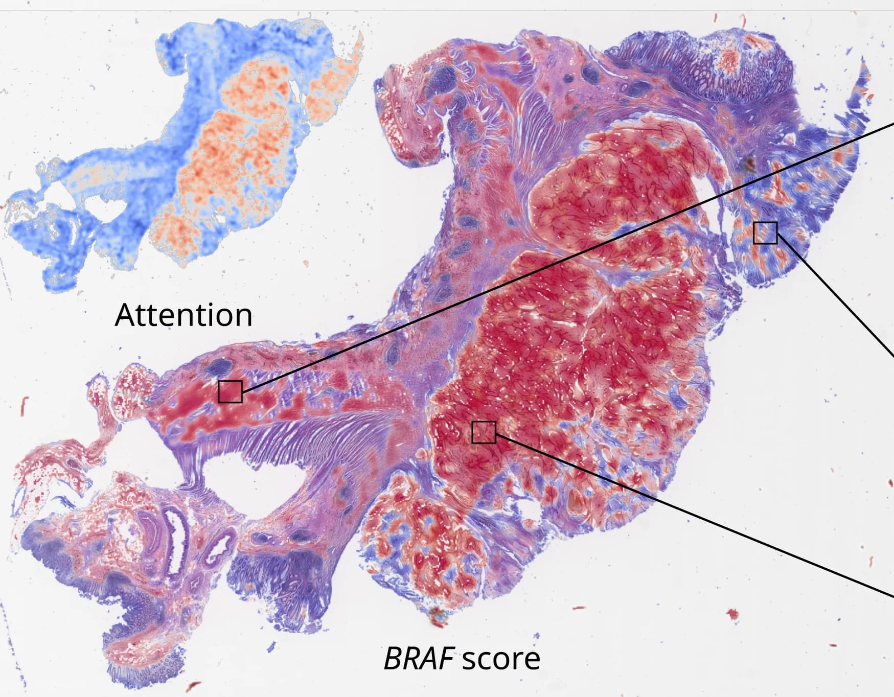 Open access visualization of Microscopy, BRAF Score, Attention Map, MSI-positive Patient, BRAF-positive Patient