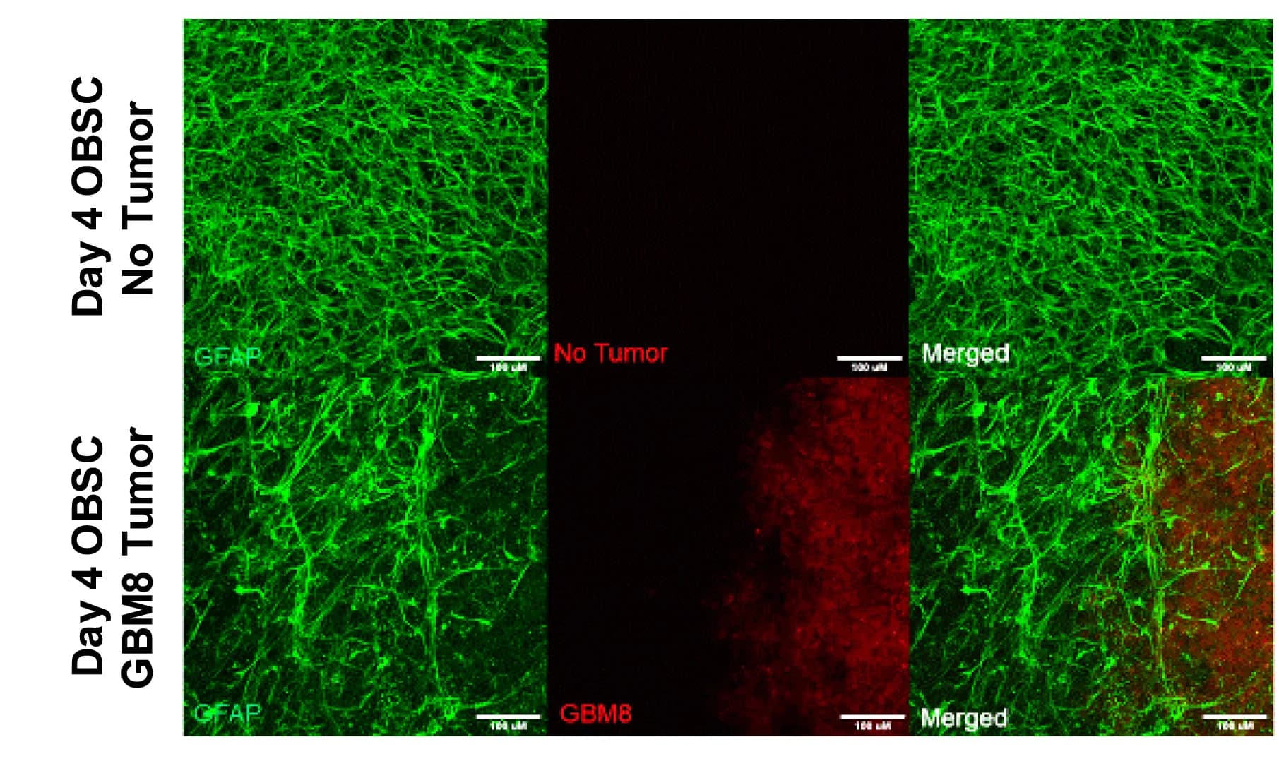 Open access visualization of Microscopy, Immunofluorescence, Astrocytes, Tumor Interaction, Tumor Cells