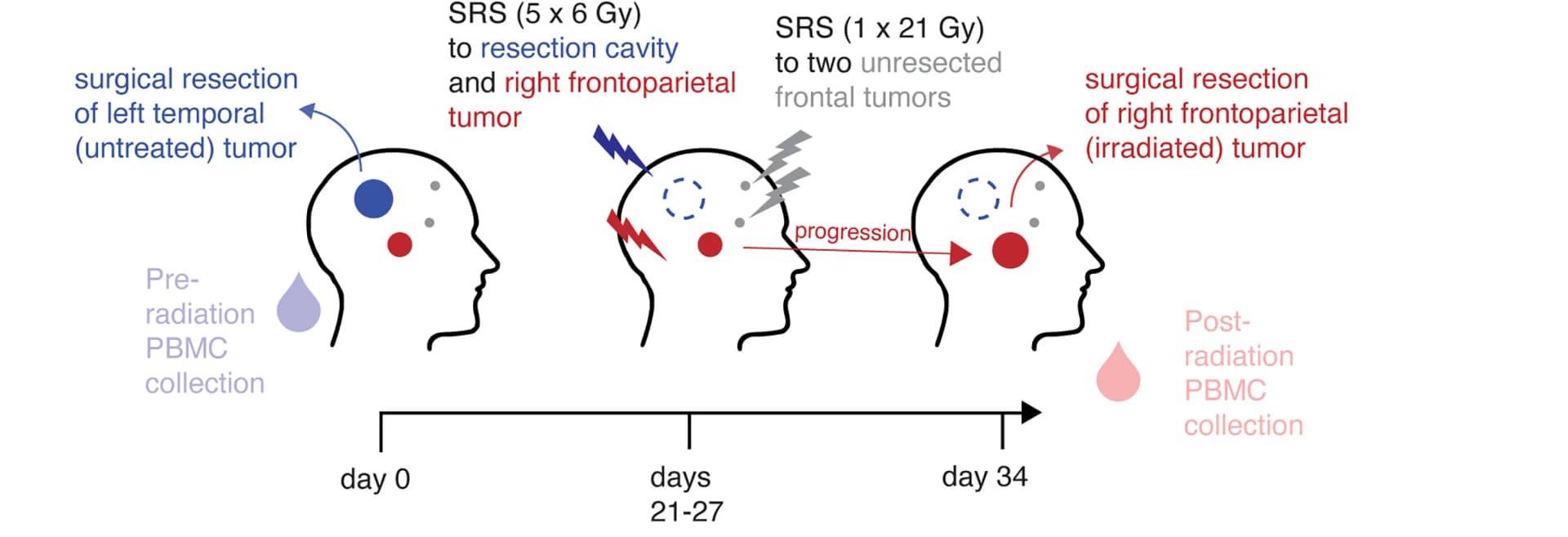 Open access visualization of Workflow, Illustration, NSCLC Metastases, Stereotactic Radiosurgery, PBMCs