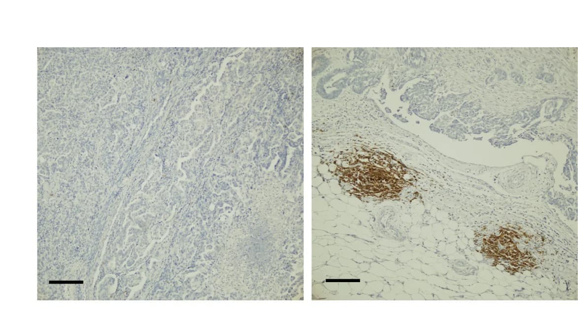 Open access visualization of Microscopy, Immunohistochemistry, CD20, Ovarian Tumor Tissues, TLS