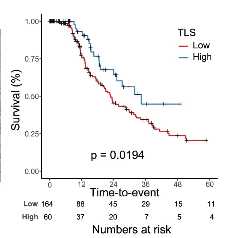 Open access visualization of Survival Curve, Kaplan-Meier Plots, TLS, Progression-Free Survival