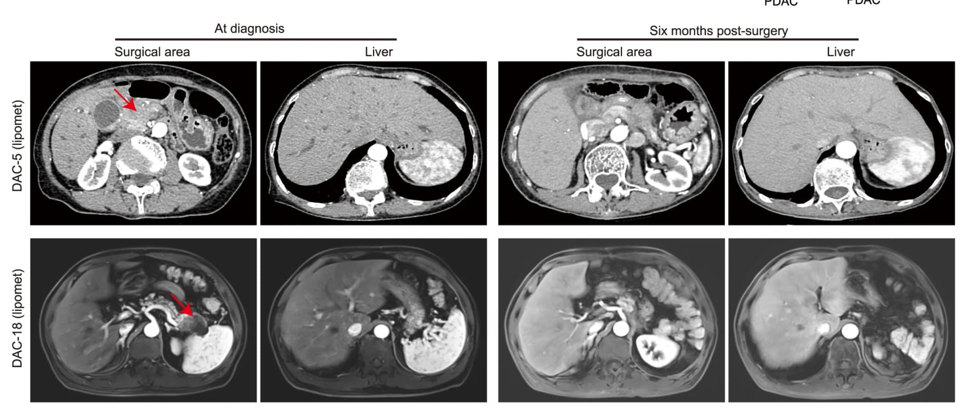 Open access visualization of Microscopy, Radiation examination, Surgical area, Liver, Lipomet-PDAC