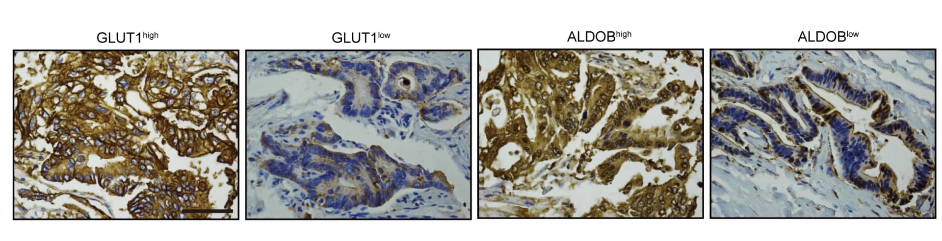 Open access visualization of Microscopy, Photo, Immunohistochemical Staining, GLUT1, ALDOB