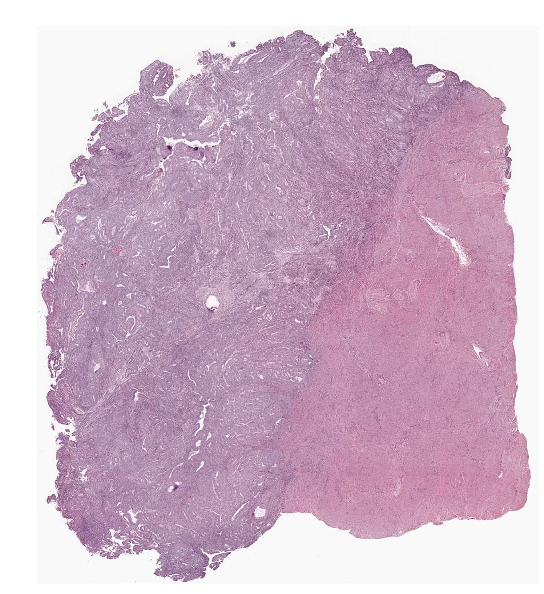 Open access visualization of Microscopy, UCEC Slide, Tumor Tissue, Normal Tissue