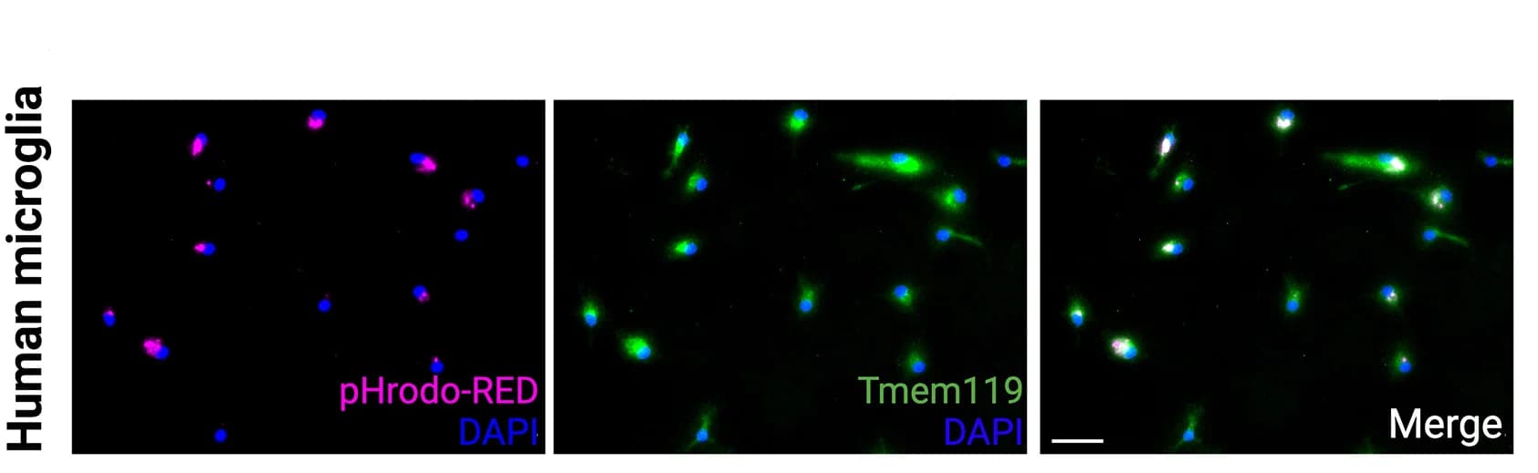 Open access visualization of Microscopy, Immunocytochemistry, Microglia, Peritumoral Tissue, TMEM119