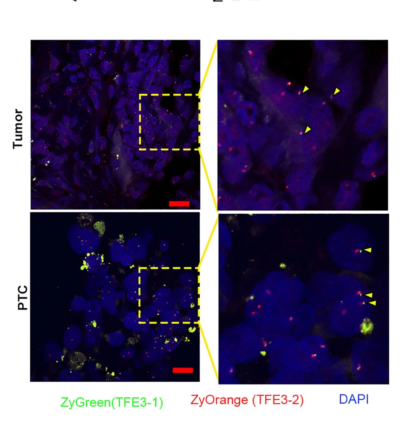 Open access visualization of Microscopy, Gene Fusion, FISH, Alveolar Soft Tissue Sarcoma
