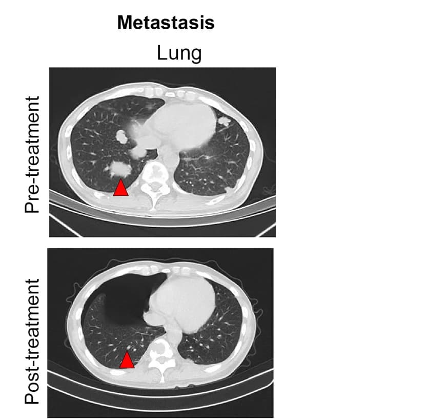 Open access visualization of Photo, CT Images, Treatments, Lung