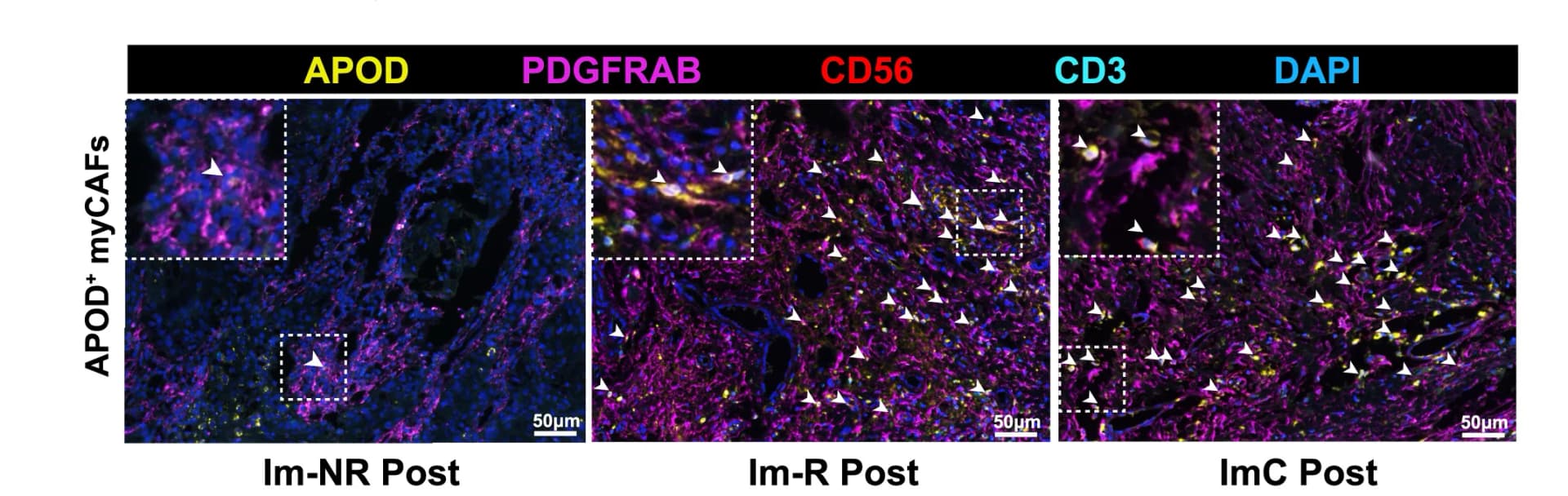 Open access visualization of Microscopy, mIHC Staining, APOD+myCAFs, Post-Treatment Samples