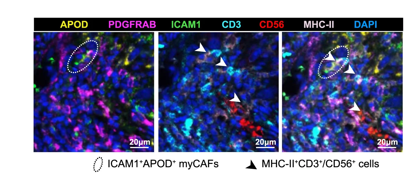 Open access visualization of Microscopy, ICAM1+APOD+myCAFs, MHC-II+CD3+/CD56+Cells, Representative Image, Scale Bar