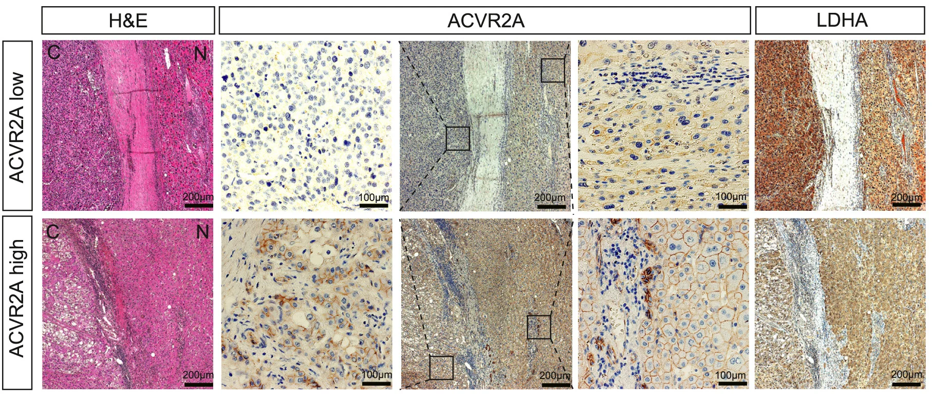 Open access visualization of Microscopy, Immunohistochemistry, ACVR2A, LDHA, HCC Samples