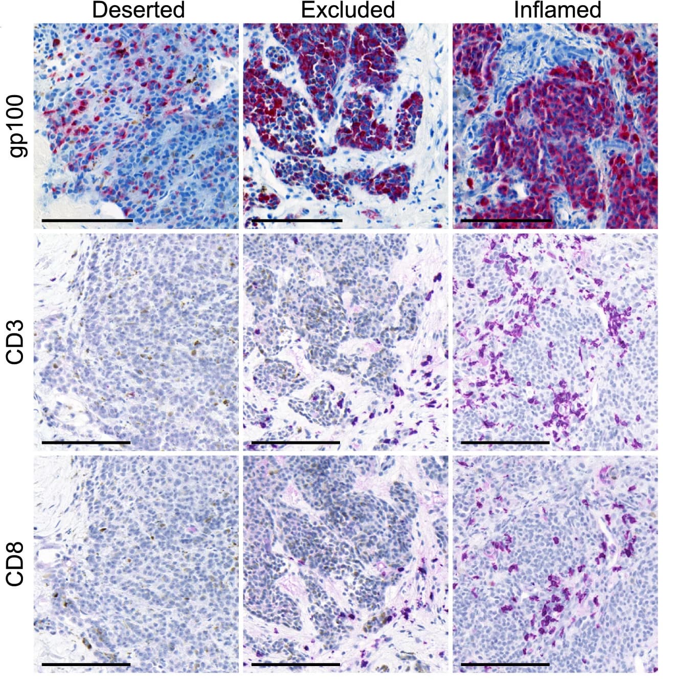 Open access visualization of Microscopy, Tumor Biopsies, IHC, gp100, CD3