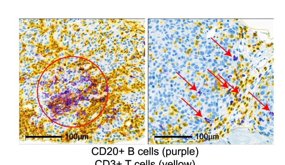 Open access visualization of Microscopy, Photo, B Cells, Lymphoid Aggregates, CD20