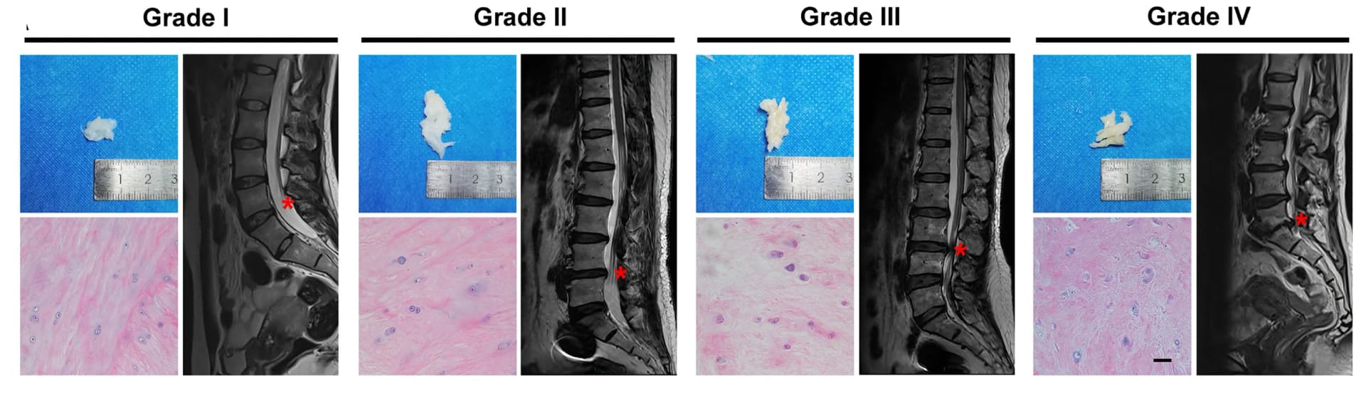 Open access visualization of Microscopy, Photo, H&E Staining, NP Tissues, Degenerative Grades