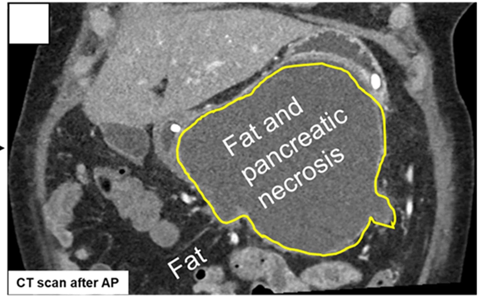 Open access visualization of Photo, CT Scan, Fat Necrosis, Pancreatitis
