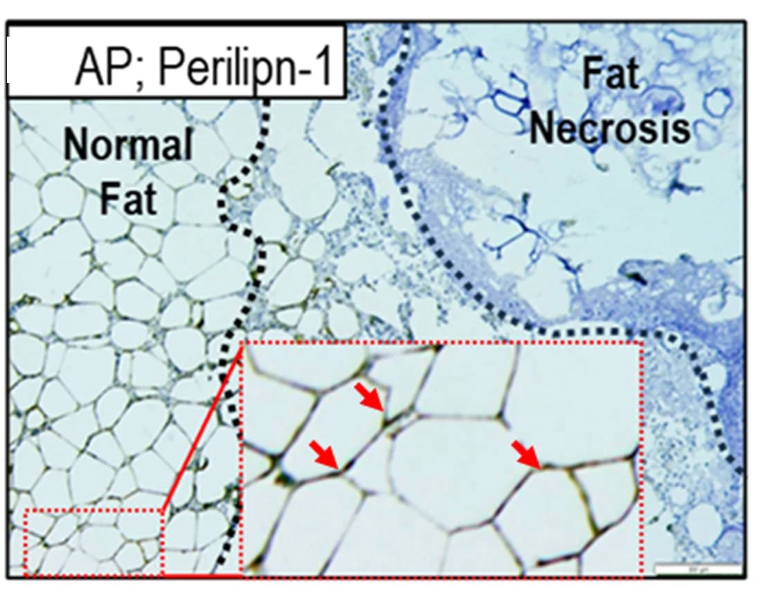 Open access visualization of Microscopy, Visceral Fat, Acute Pancreatitis, Immunohistochemistry, Perilipin-1