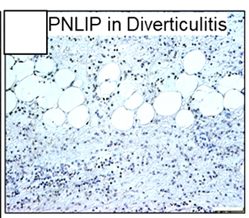 Open access visualization of Microscopy, Immunohistochemistry, PNLIP, Human Diverticulitis