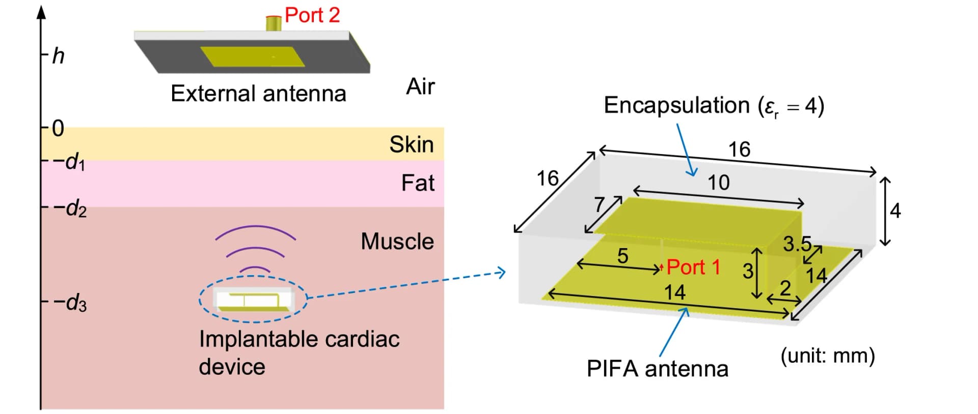 Open access visualization of Illustration, Wireless System, Implantable Cardiac Device, Transmitter, External Antenna