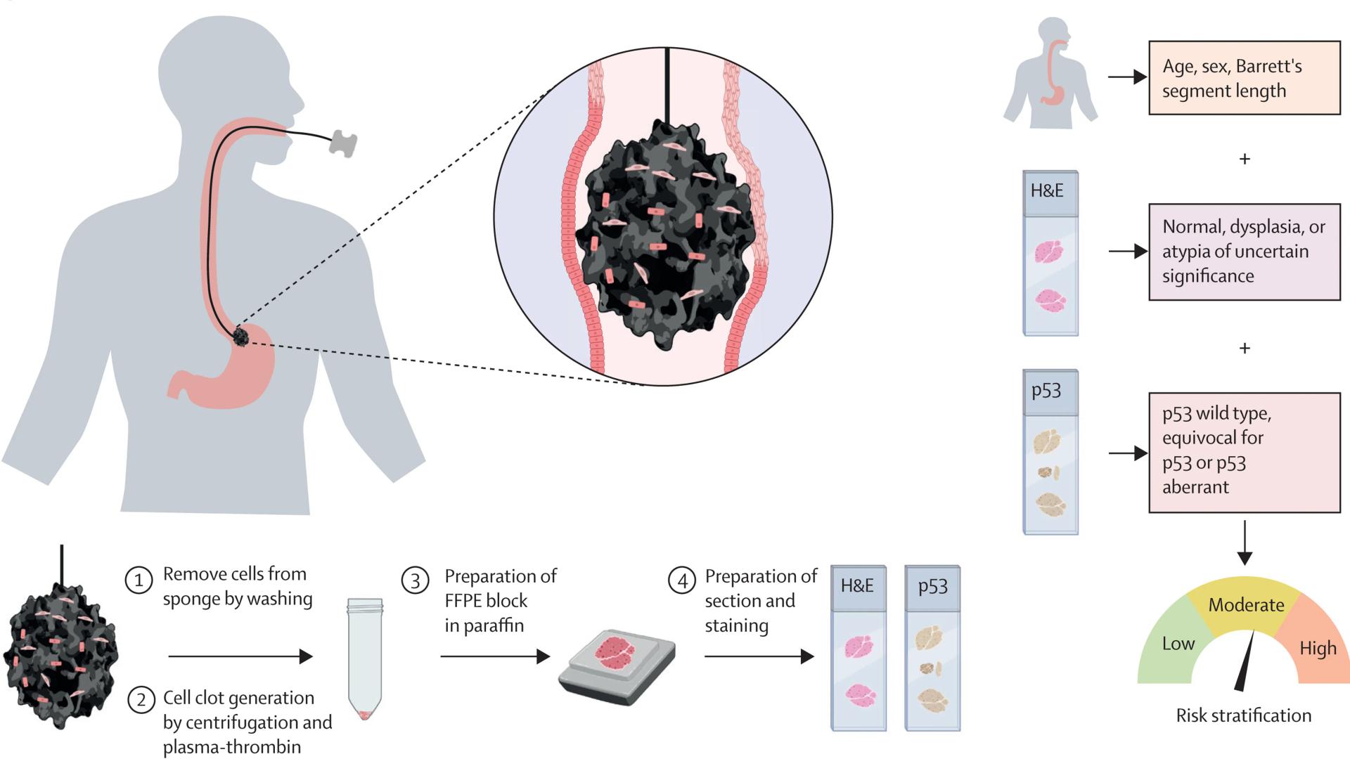 Open access visualization of Workflow, Illustration, Capsule Sponge, H&E Staining, p53 Staining