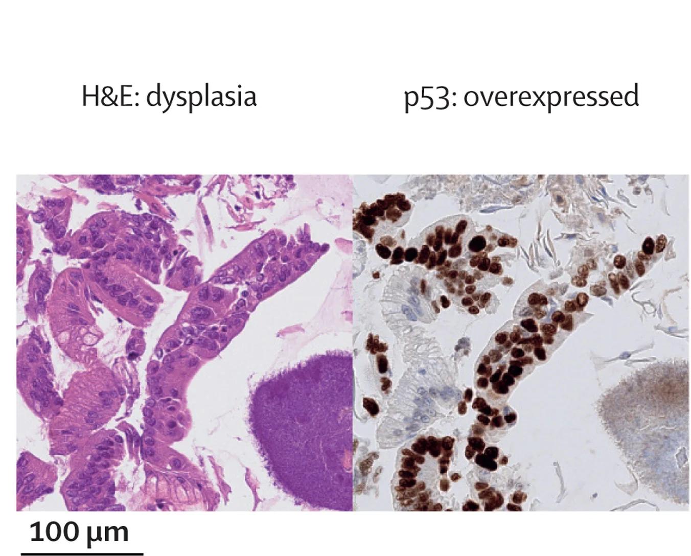 Open access visualization of Microscopy, Capsule Sponge, H&E Staining, p53 Staining, Glandular Atypia