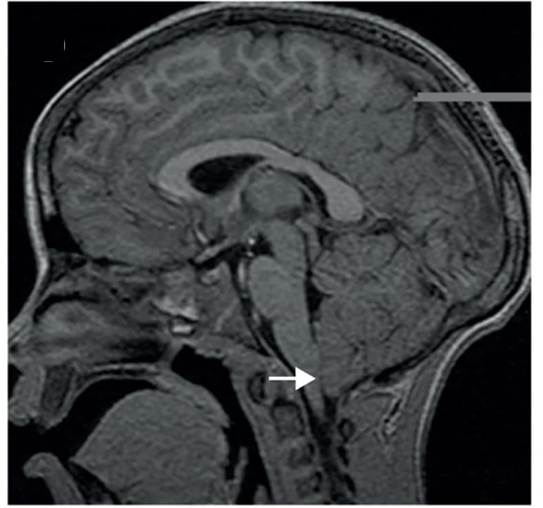 Open access visualization of Photo, Cerebral Malaria, Cortical Oedema, Descent of Cerebellar Tonsils, Sagittal T1