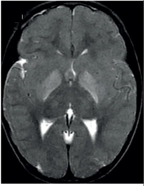 Open access visualization of Microscopy, Cerebral Malaria, T2 Hyperintensity, Basal Ganglia