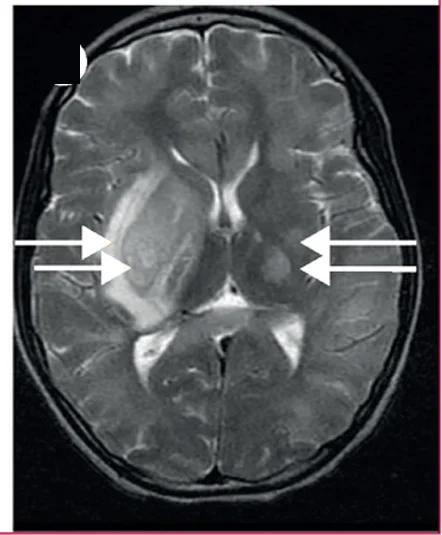 Open access visualization of Photo, S Pneumoniae Meningitis, Cerebral Cortex, Left Parietal Cortex, Right Frontal Cortex