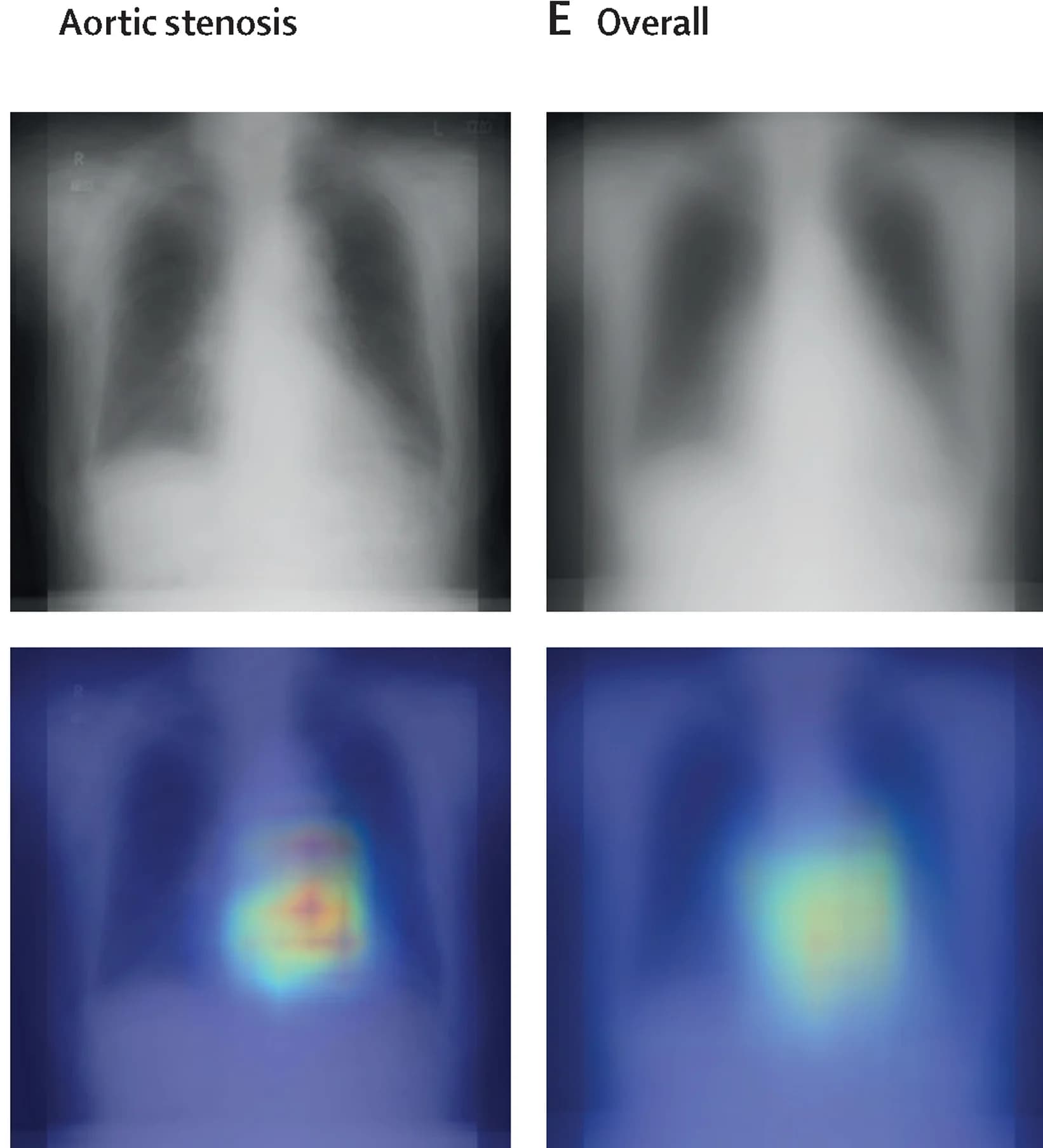 Open access visualization of Photo, Microscopy, Chest Radiograph, Saliency Map, Aortic Stenosis
