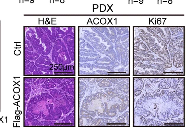 Open access visualization of Microscopy, Tumor Cell Proliferation, ACOX1 Overexpression, PDXs, H&E