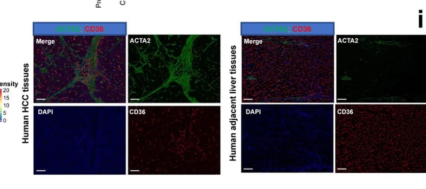 Open access visualization of Microscopy, mIF, CD36+ CAFs, Human HCC, Liver Tissues