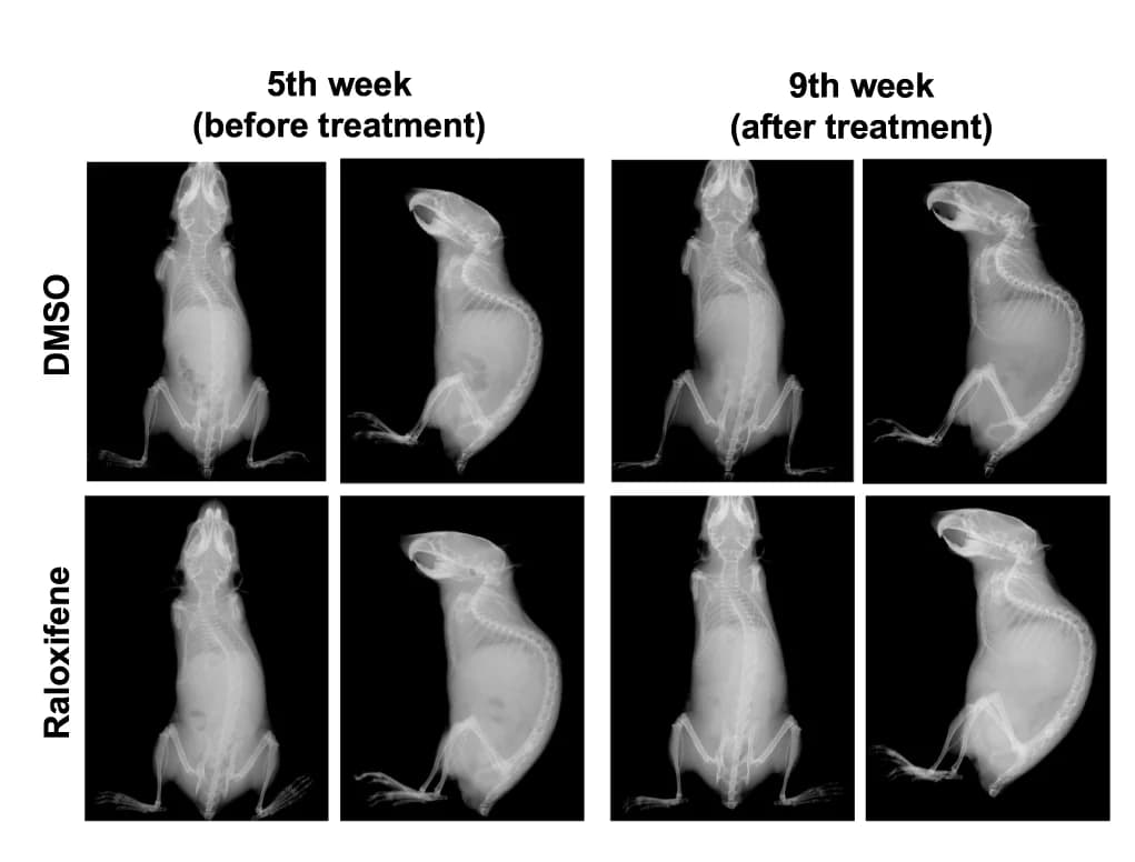 Open access visualization of Photo, X-ray Images, Spinal Alignment, Raloxifene