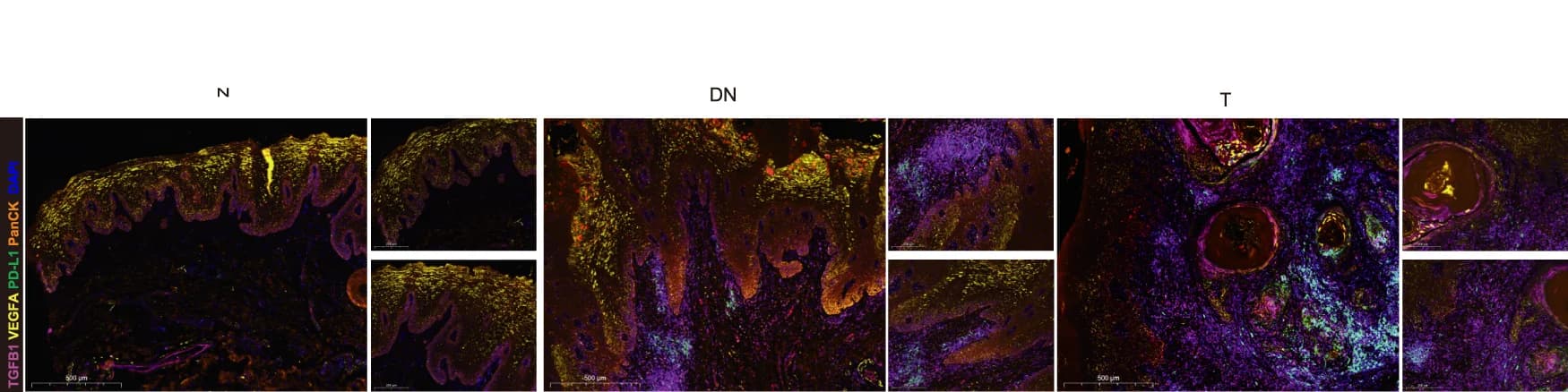 Open access visualization of Microscopy, mIHC Staining, VEGFA, PD-L1, TGFB1