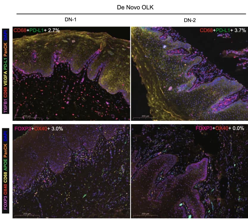 Open access visualization of Microscopy, mIHC staining, PD-L1, TGF1, VEGFA