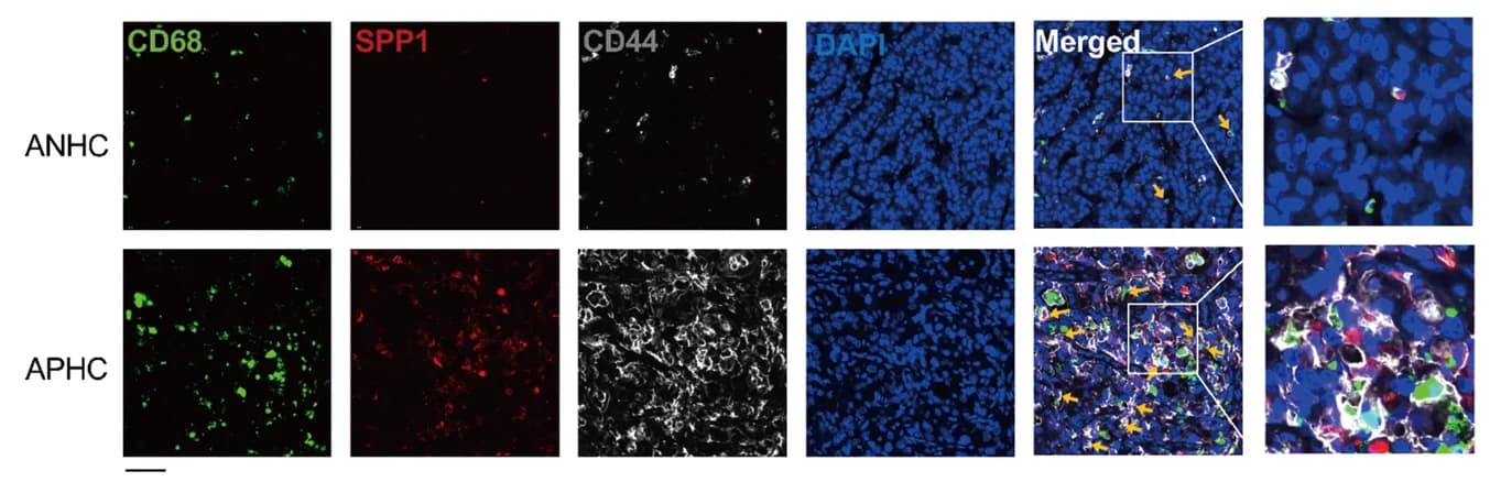 Open access visualization of Microscopy, Multiplex IHC, TAM-SPP1, CD68, SPP1