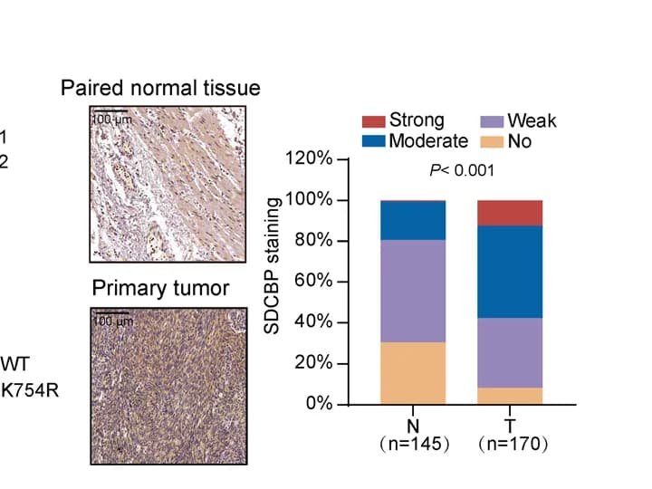 Open access visualization of Stacked Bar Plot, Microscopy, SDCBP, Tumor Tissue Microarray, ESCC Tissues