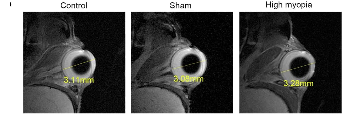 Open access visualization of Microscopy, Ocular MRI, Myopia, Eye, AL